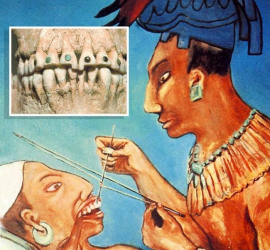 Инкрустация камней в зубы