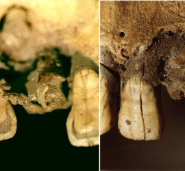 Первая в истории шина зубов