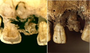 Первая в истории шина зубов
