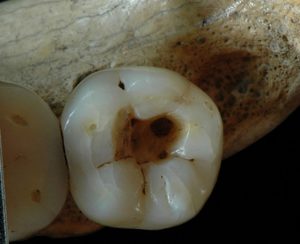 Первое в истории человека препарирование зуба