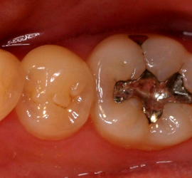 Пломба из серебряной амальгамы