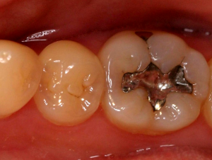 Пломба из серебряной амальгамы