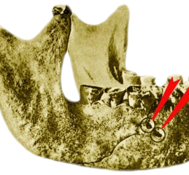 Трепанация нижней челюсти