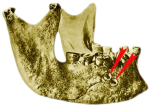Трепанация нижней челюсти