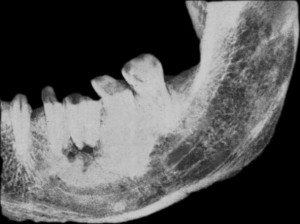 Периодонтит