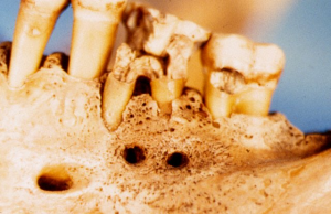 Трепанация нижней челюсти