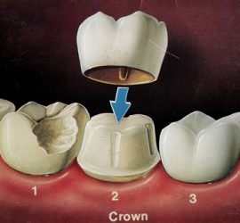 Фарфоровая коронка