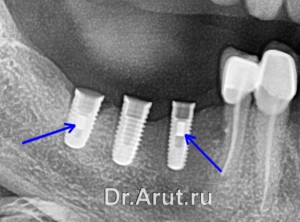 Сломанный винт на рентгенограмме