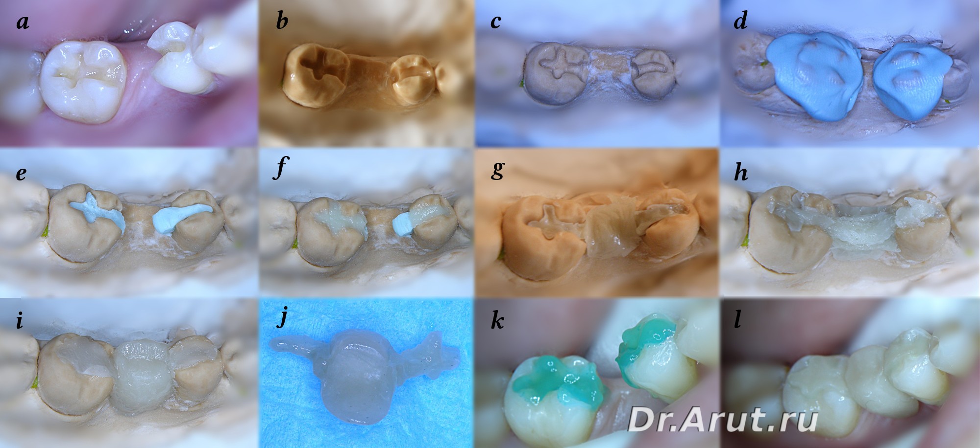 Изготовление АМП по методике Ервандяна.