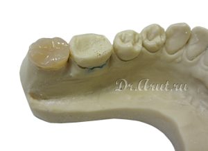 Композитная вкладка на модели