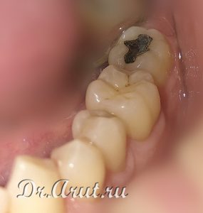 Амальгамовая пломба после полировки