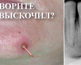 Говорите прыщ?