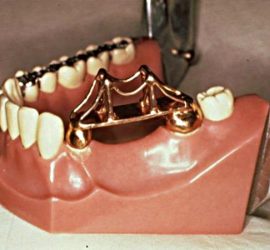 Зубной мост