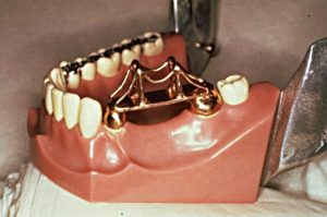 Зубной мост