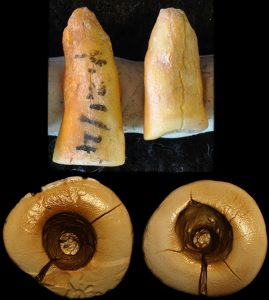 Каналы резцов, запломбированные битумом.