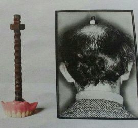 Протез с болтом