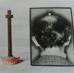 Протез с болтом