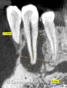 33 зуб с периапикальным абсцессом