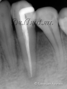 33 зуб после пломбирования корневого канала