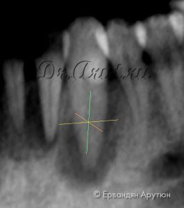 33 зуб с периапикальным абсцессом
