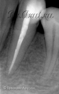 33 через год после пломбирования корневого канала