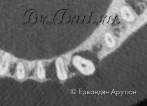 33 зуб с периапикальным абсцессом