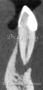 33 зуб с периапикальным абсцессом