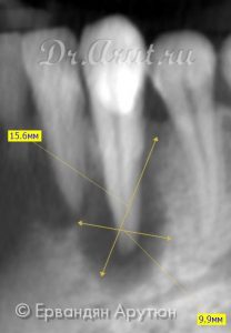 33 зуб с периапикальным абсцессом