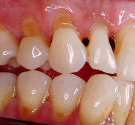 Клиновидный дефект (абфракция)