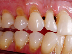 Клиновидный дефект (абфракция)